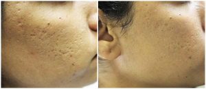 Micro Needling Before and After Photo (Skin Needling)